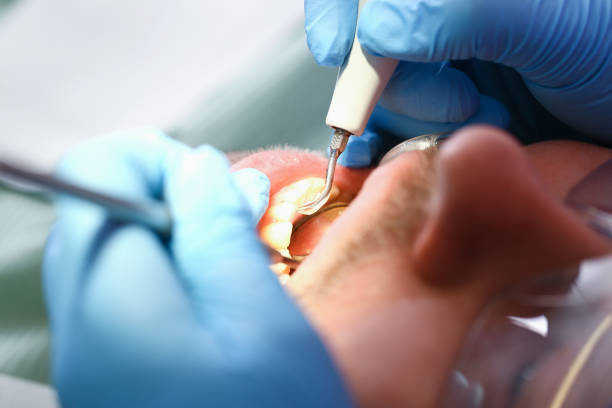 Best Emergency Treatment for Dental Infections or Abscesses in Syosset, NY